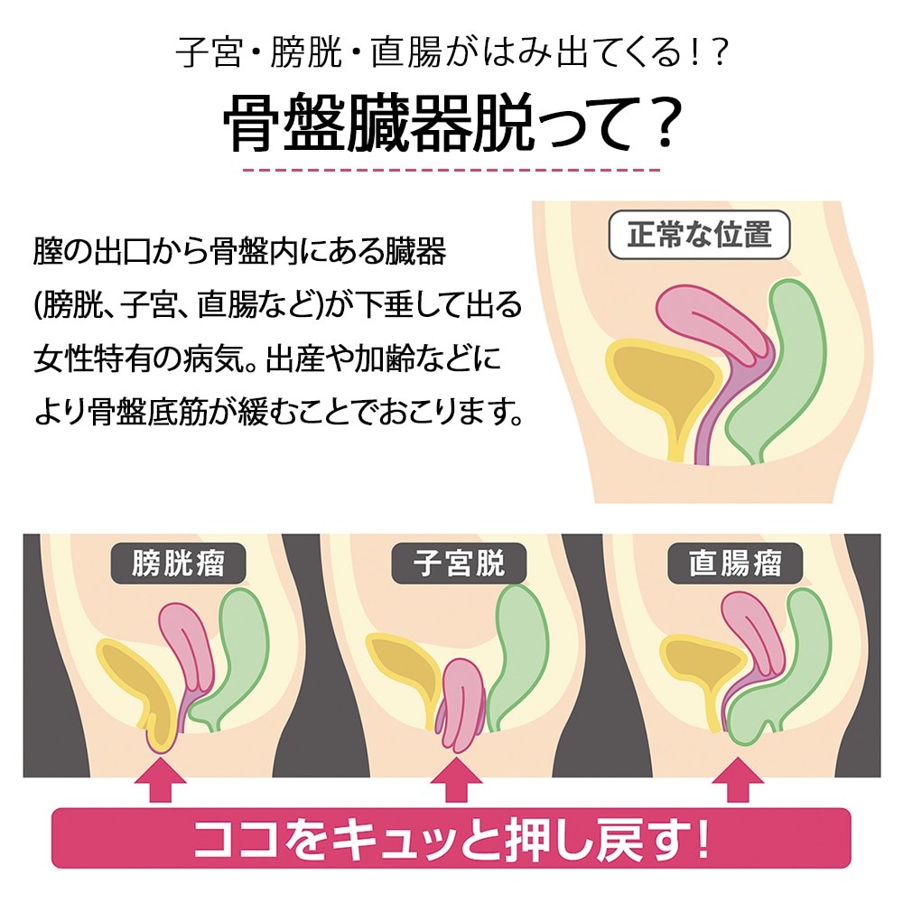 骨盤臓器脱サポーター